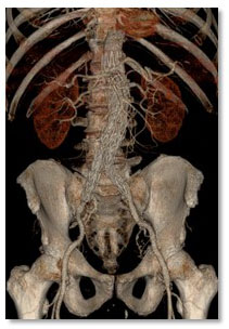 3d-aorta-with-shadow.jpg