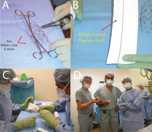 Fig 3, A-D, Construction of hand made TEVAR stent graft by connecting two 40mm x 5cm Z stents (A) to a 38mm ironed dacron graft (B). Back table reconstruction by Drs. Mark Eskandari and Melina Kibbe (C), and surgical team after graft implantation Drs. Jon Matsumura, Mark Eskandari, and Melina Kibbe (D)