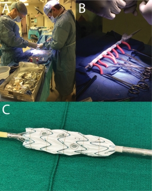 Figure 4: Back table modification of a thoracic aortic endograft for use in the viseceral segment aorta by Drs. Andrew Hoel and Tadaki Tomita (A). Thoracic aortic endograft reconstrained for replacement in its original delivery system after back table customization (B). Infrarenal bifurcated aortic endograft modified for use in the visceral segment aorta (C)