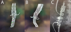 Figure 5: Completion cone beam CT used as objective measurement of satisfactory complex endovascular aortic reconstruction using a Cook Zenith Fenestrated Plus device (A), Gore Thoracoabdominal Branch Endoprosthesis (B), and physician modified Cook Zenith Alpha (C). 