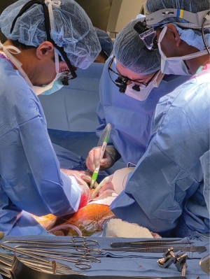 Figure 6: Open extent IV thoracoabdominal aortic reconstruction for failed aortic endograft performed by Northwestern integrated vascular surgery alum Dr. Neel Mansukhani, and current integrated vascular surgery residents Dr. Margaret Reilly and Shaunak Roy.
