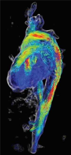 Figure 7: 4D MRI of a subacute uncomplicated type B dissection in a lateral projection 